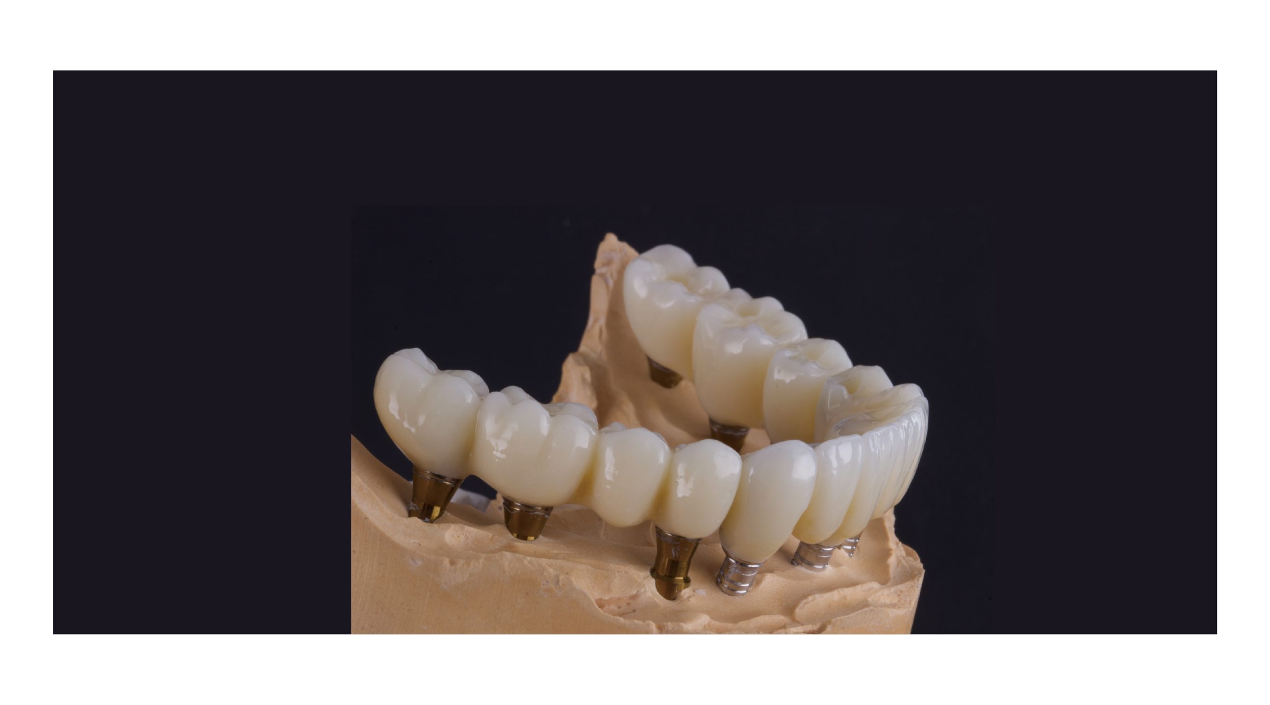 A high-strength full-arch implant bridge restoration milled from Mammudent HT-White zirconia disc.
